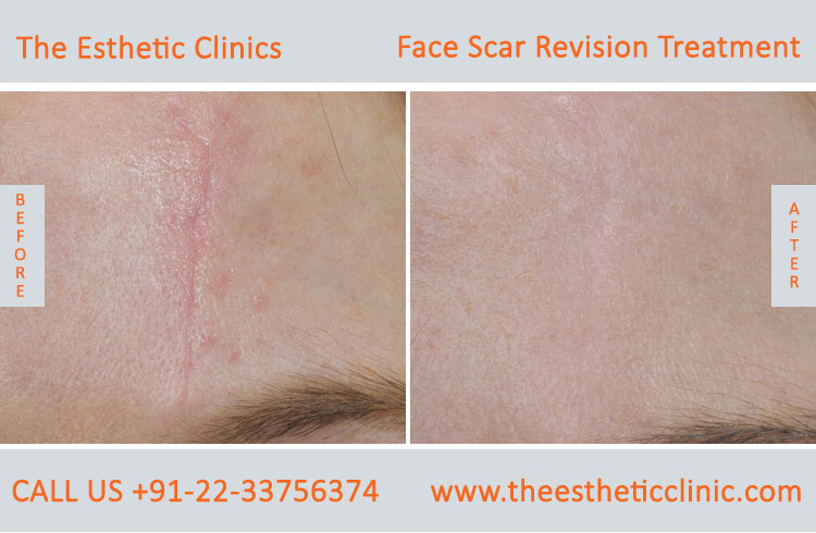 Facial Scars Revision laser Treatment for Face before after photos in mumbai india (2)